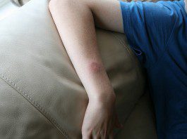 paintball blessure
